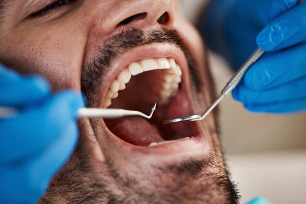 Best Knocked-Out Tooth (Avulsed Tooth) Treatment in Sun Village, CA
